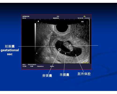 单身家庭三代试管婴儿费用解析与准备指南