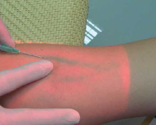 上海供卵试管医院选择与睾丸无精子但有生精细胞的助孕方案探讨